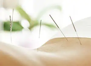 דיקור יפני